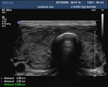 Ultraschall Der Schilddrüse | Universitätsklinikum Ulm