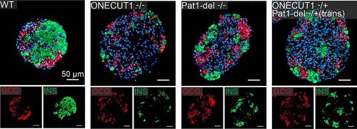 Pankreasinseln wurden im Labor aus Stammzellen generiert, die die Mutationen des Patienten tragen. Dabei wird deutlich, dass Insulin-produzierende Beta-Zellen (in grün) in den veränderten Inseln seltener vorkommen. Andere Zelltypen wie Glukagon-produzierende Alpha-Zellen (in rot) zeigen keine sichtbaren Veränderungen. Die Abbildung zeigt eine unveränderte Insel (links; WT) im Vergleich zu drei Inseln mit Mutationen (rechts)