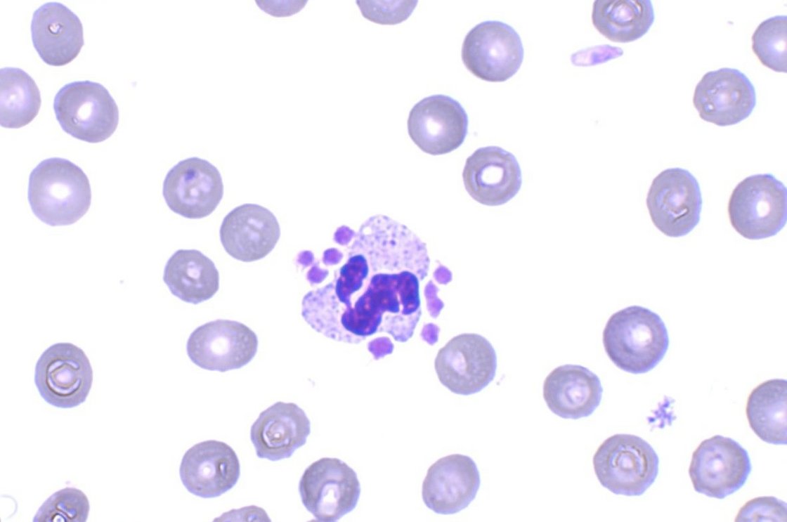 Hemacolor-stained blood smear showing a platelet-neutrophil complex (PNC)