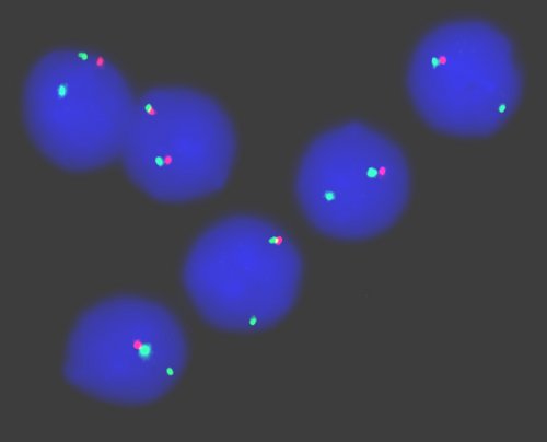 Leukämiezellen, in deren Zellkern sich lediglich ein rotes Signal findet, haben einen Teil des Chromosoms 17 verloren. Das führt zu Resistenz gegen Chemotherapie und Zelltod.