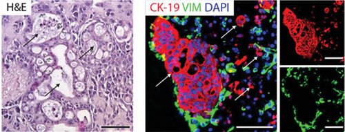 Histologischer Schnitt (links) und Immunfluoreszenzfärbungen (rechts) von Pankreaskarzinom-Organoiden sowie Pankreas-Sternzellen als „Assembloide“, die auf einer zellbereinigten Schweineblase kultiviert wurden. Die Pfeile zeigen auf Tumordrüsen umrandet von sogenannten Krebs-assoziierten Fibroblasten